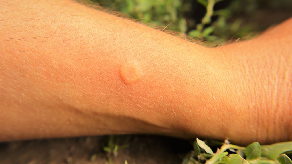 Wasp Sting